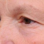 Eyelid Surgery Before & After Patient #1530