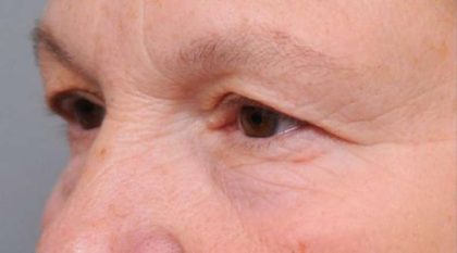 Eyelid Surgery Before & After Patient #1530