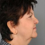Eyelid Surgery Before & After Patient #1540