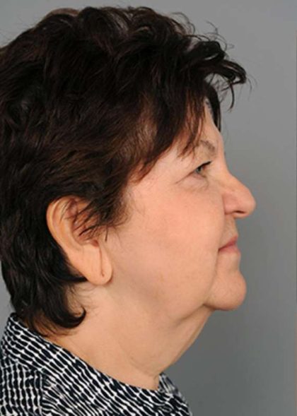 Eyelid Surgery Before & After Patient #1540