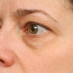 Eyelid Surgery Before & After Patient #1550