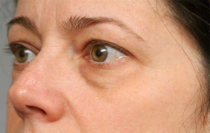 Eyelid Surgery Before & After Patient #1550