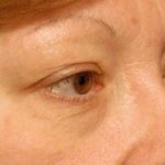 Eyelid Surgery Before & After Patient #1557