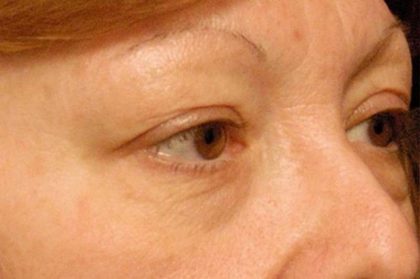 Eyelid Surgery Before & After Patient #1557
