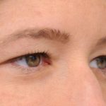 Eyelid Surgery Before & After Patient #1565
