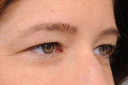 Eyelid Surgery Before & After Patient #1565