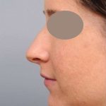 Rhinoplasty Before & After Patient #1572