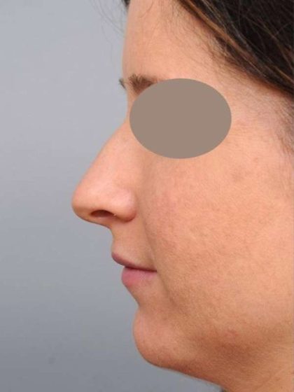 Rhinoplasty Before & After Patient #1572