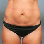 Tummy Tuck Before & After Patient #363