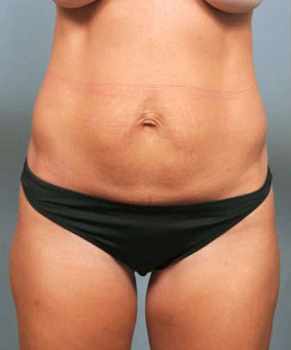 Tummy Tuck Before & After Patient #363