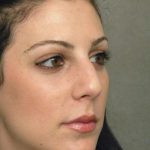 Rhinoplasty Before & After Patient #1579