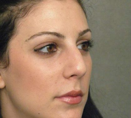 Rhinoplasty Before & After Patient #1579