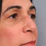 Rhinoplasty Before & After Patient #1586
