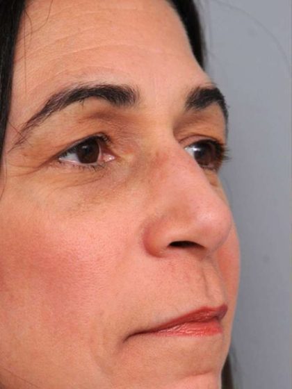 Rhinoplasty Before & After Patient #1586
