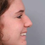Rhinoplasty Before & After Patient #1591