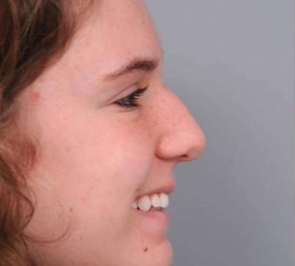 Rhinoplasty Before & After Patient #1591