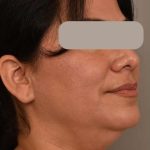 Neck Lift (Traditional) Before & After Patient #1596