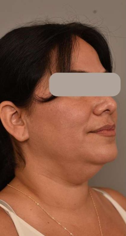 Neck Lift (Traditional) Before & After Patient #1596