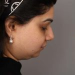Neck Lift (Traditional) Before & After Patient #1605