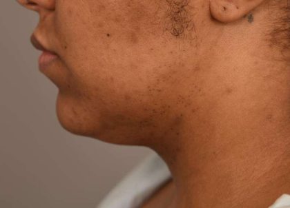 Neck Lift (Traditional) Before & After Patient #1621