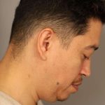 Mini Neck Lift (Single Incision) Before & After Patient #1630