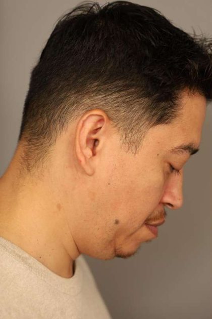 Mini Neck Lift (Single Incision) Before & After Patient #1630
