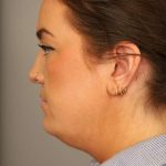 Mini Neck Lift (Single Incision) Before & After Patient #1637