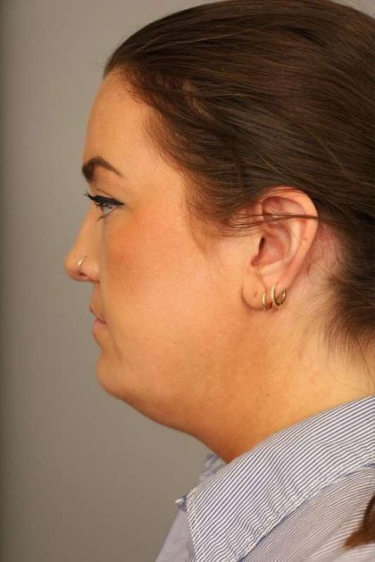 Mini Neck Lift (Single Incision) Before & After Patient #1637