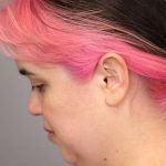 Mini Neck Lift (Single Incision) Before & After Patient #1646