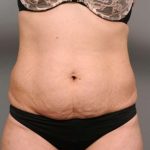 Tummy Tuck Before & After Patient #370