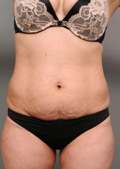Tummy Tuck Before & After Patient #370