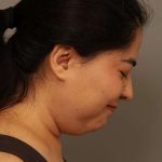 Mini Neck Lift (Single Incision) Before & After Patient #1662