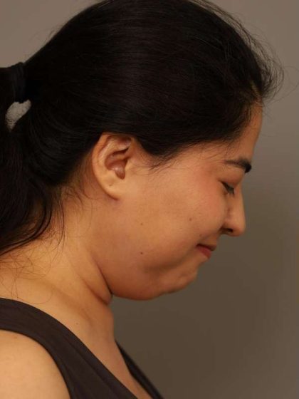 Mini Neck Lift (Single Incision) Before & After Patient #1662