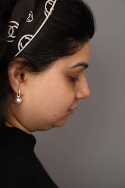 Mini Neck Lift (Single Incision) Before & After Patient #1671