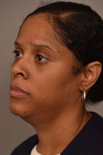 Mini Neck Lift (Single Incision) Before & After Patient #1679