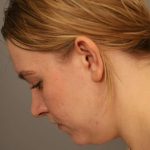 Mini Neck Lift (Single Incision) Before & After Patient #1690