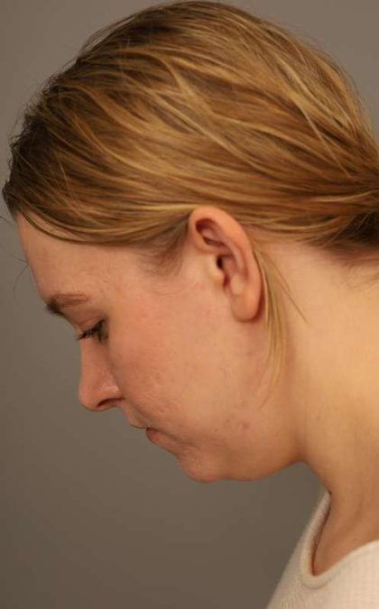Mini Neck Lift (Single Incision) Before & After Patient #1690