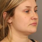 Neck Liposuction / Chin Liposuction Before & After Patient #1703
