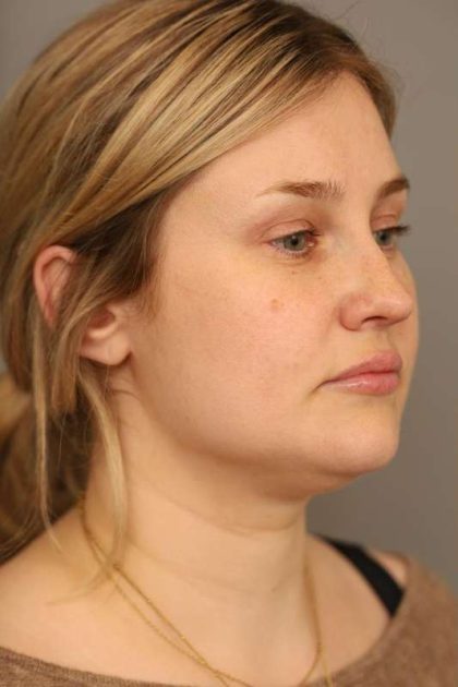 Neck Liposuction / Chin Liposuction Before & After Patient #1703
