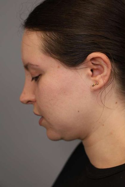 Neck Liposuction / Chin Liposuction Before & After Patient #1712