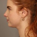 Neck Liposuction / Chin Liposuction Before & After Patient #1719