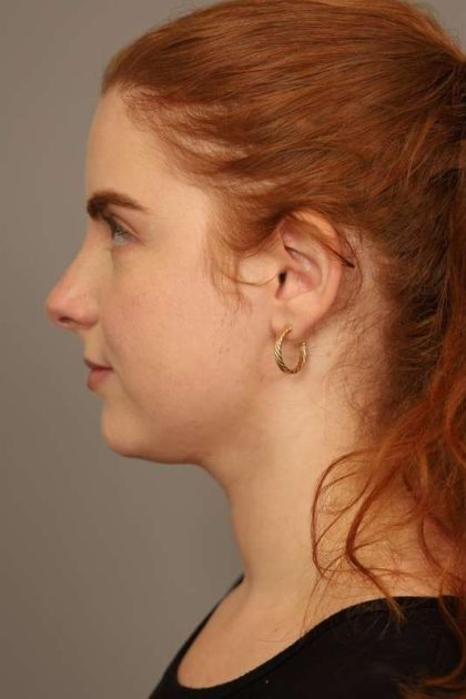 Neck Liposuction / Chin Liposuction Before & After Patient #1719