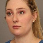 Neck Liposuction / Chin Liposuction Before & After Patient #1734