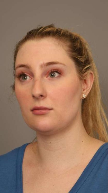 Neck Liposuction / Chin Liposuction Before & After Patient #1734