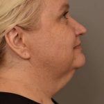 Neck Liposuction / Chin Liposuction Before & After Patient #1743