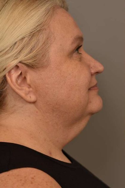 Neck Liposuction / Chin Liposuction Before & After Patient #1743