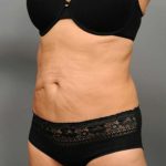 Tummy Tuck Before & After Patient #377