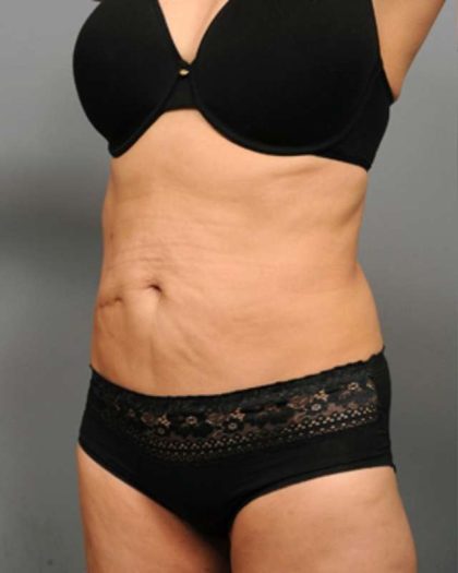 Tummy Tuck Before & After Patient #377