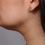 Neck Liposuction / Chin Liposuction Before & After Patient #1770