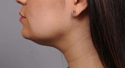 Neck Liposuction / Chin Liposuction Before & After Patient #1770